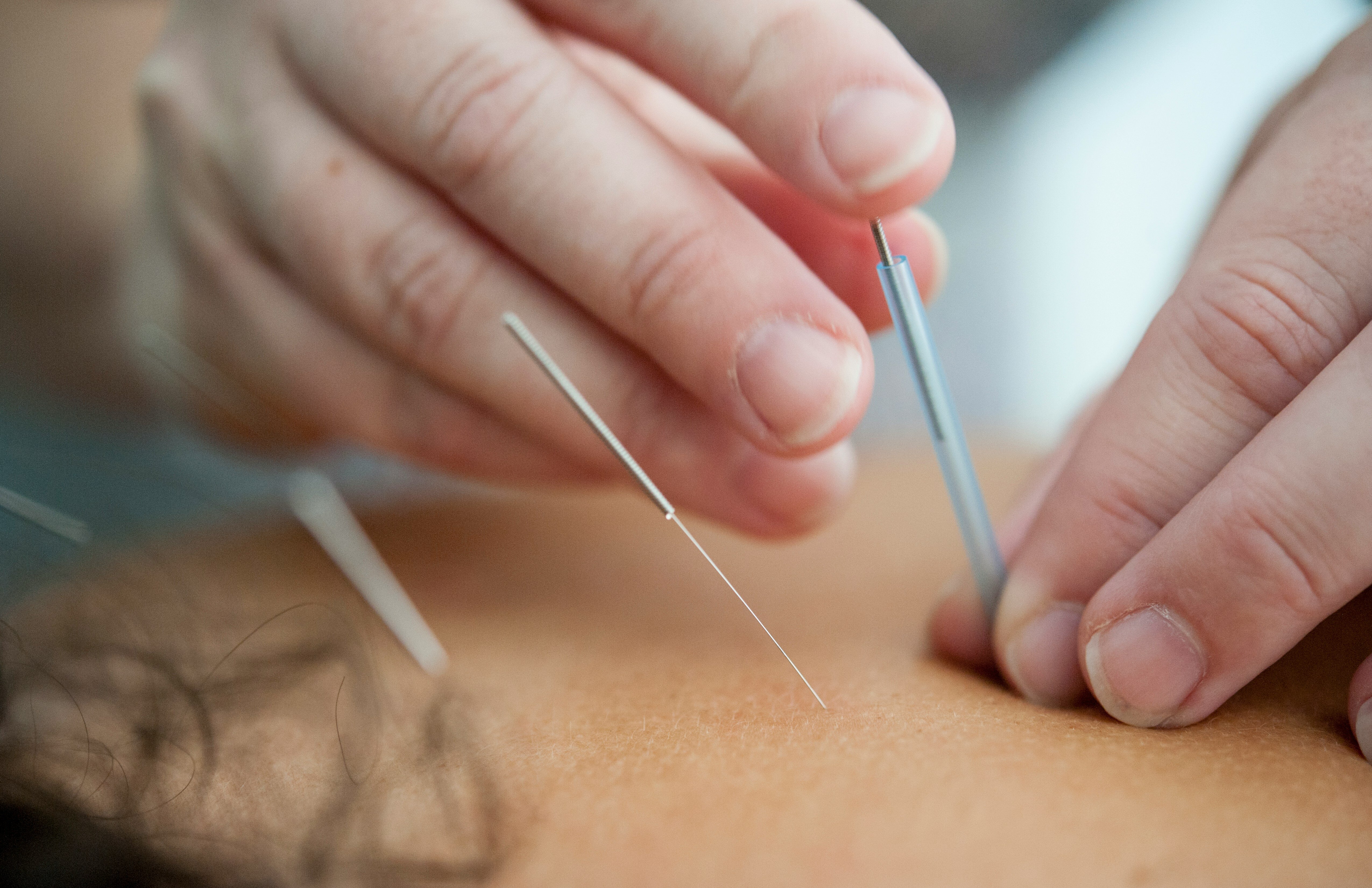 Dry Needling Austin